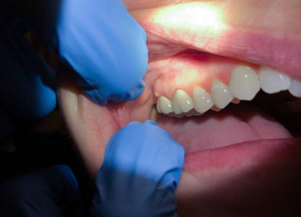 Best Emergency Treatment for Dental Infections or Abscesses in Kraemer, LA